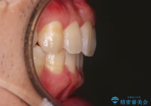 【インビザライン】目立たない矯正で前歯を綺麗にの治療後