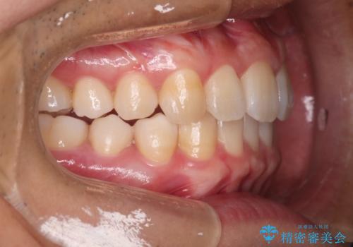 【インビザライン】目立たない矯正で前歯を綺麗にの治療後
