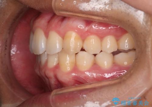 【インビザライン】目立たない矯正で前歯を綺麗にの治療後