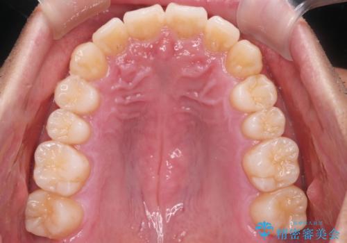 【インビザライン】目立たない矯正で前歯を綺麗にの治療後