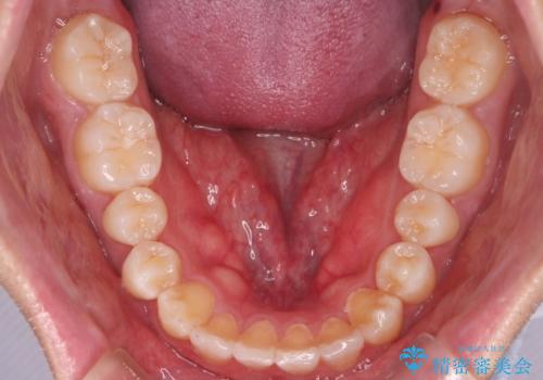 【インビザライン】目立たない矯正で前歯を綺麗にの治療後