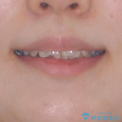 全顎的なデコボコと口元の突出感 ワイヤー装置での抜歯矯正で整った口元にの治療前(顔貌)