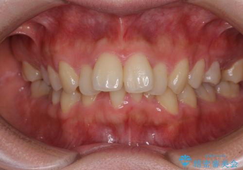 全顎的なデコボコと口元の突出感 ワイヤー装置での抜歯矯正で整った口元にの症例 治療前