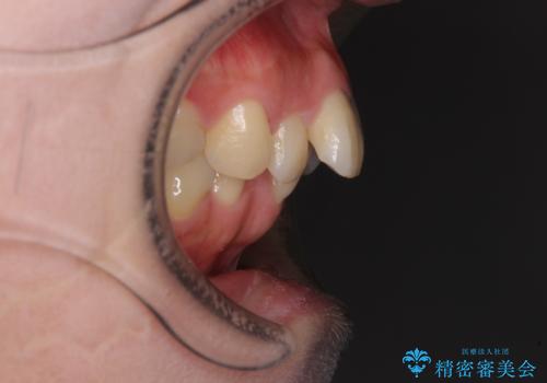 全顎的なデコボコと口元の突出感 ワイヤー装置での抜歯矯正で整った口元にの治療前