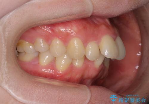 全顎的なデコボコと口元の突出感 ワイヤー装置での抜歯矯正で整った口元にの治療前