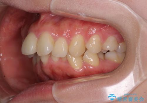 全顎的なデコボコと口元の突出感 ワイヤー装置での抜歯矯正で整った口元にの治療前