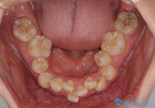 全顎的なデコボコと口元の突出感 ワイヤー装置での抜歯矯正で整った口元にの治療前