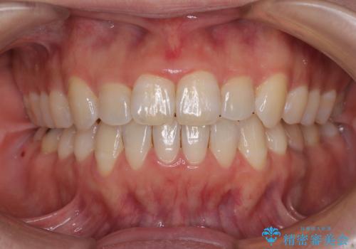 【モニター】飛び出した上顎前歯 補助装置を併用したインビザライン矯正治療の症例 治療後
