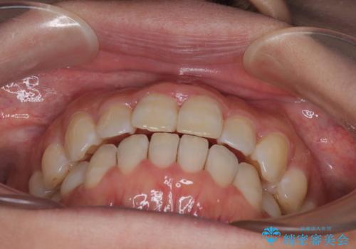 【モニター】飛び出した上顎前歯 補助装置を併用したインビザライン矯正治療の治療後