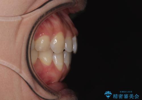 【モニター】飛び出した上顎前歯 補助装置を併用したインビザライン矯正治療の治療後