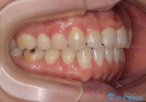 【モニター】飛び出した上顎前歯 補助装置を併用したインビザライン矯正治療の治療後