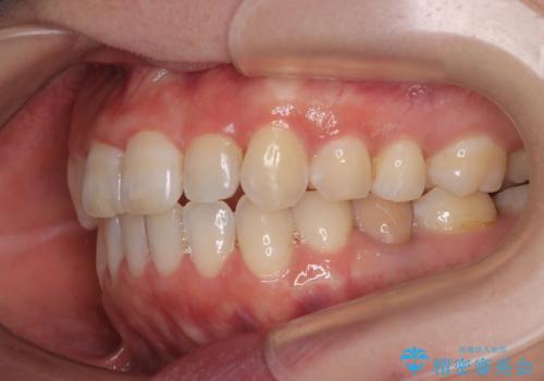 【モニター】飛び出した上顎前歯 補助装置を併用したインビザライン矯正治療の治療後