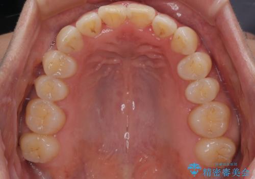 【モニター】飛び出した上顎前歯 補助装置を併用したインビザライン矯正治療の治療後