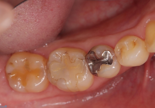 メタルフリー 即日セラミック修復の症例 治療前