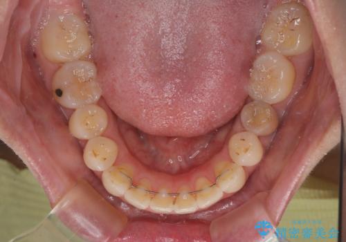 【モニター】飛び出した上顎前歯 補助装置を併用したインビザライン矯正治療の治療後