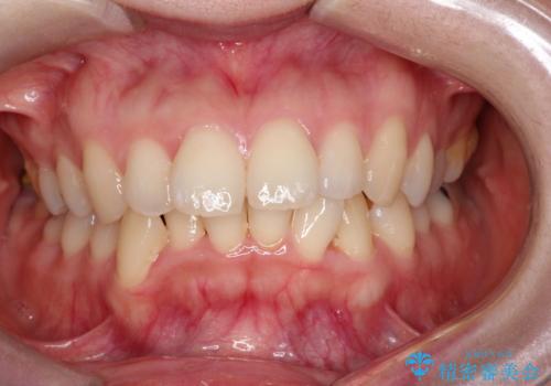 口ボコと歯のデコボコが気になる!|前歯が出ていて口が閉じにくい|審美ワイヤー矯正による口元の改善!の治療前