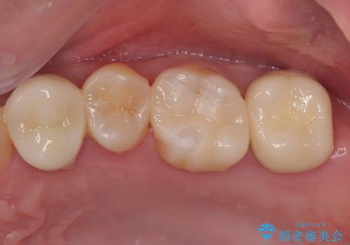 奥歯の大きなむし歯 神経を残してセラミック治療の症例 治療後