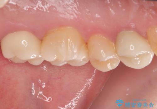 奥歯の大きなむし歯 神経を残してセラミック治療の治療後