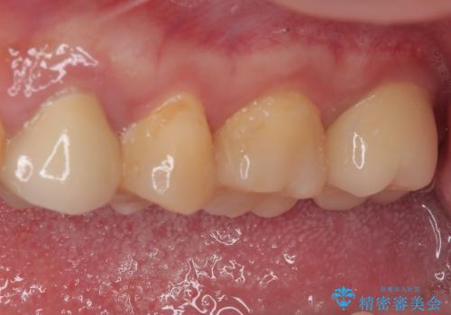 奥歯の大きなむし歯 神経を残してセラミック治療の治療後