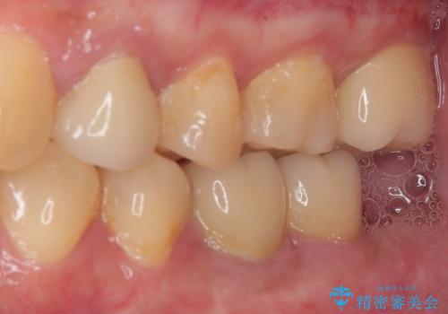 奥歯の大きなむし歯 神経を残してセラミック治療の治療後