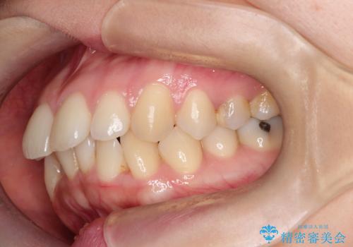 口ボコと歯のデコボコが気になる!|前歯が出ていて口が閉じにくい|審美ワイヤー矯正による口元の改善!の治療前