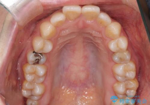 口ボコと歯のデコボコが気になる!|前歯が出ていて口が閉じにくい|審美ワイヤー矯正による口元の改善!の治療前