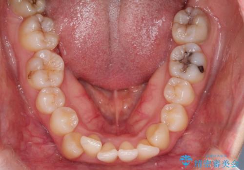 口ボコと歯のデコボコが気になる!|前歯が出ていて口が閉じにくい|審美ワイヤー矯正による口元の改善!の治療前