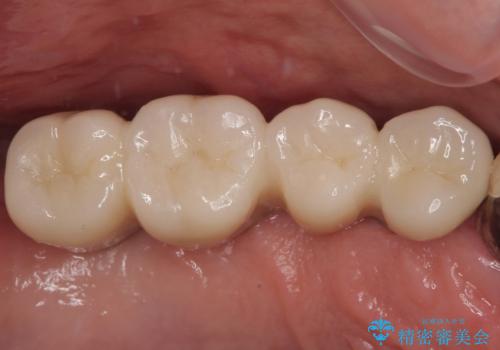 ぐらぐらする奥歯 短期間インプラント治療の症例 治療後