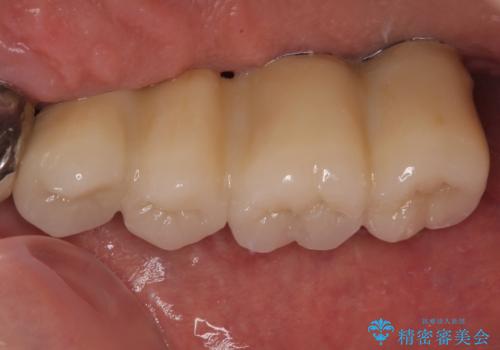 ぐらぐらする奥歯 短期間インプラント治療の治療後