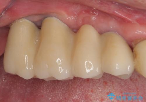 ぐらぐらする奥歯 短期間インプラント治療の治療後
