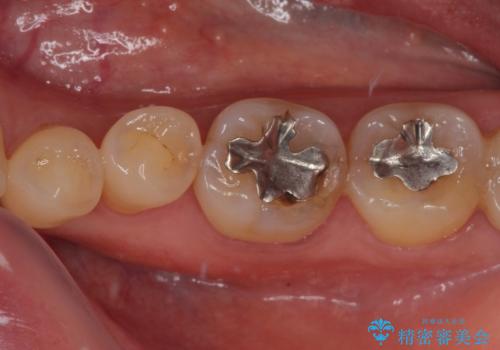 銀歯の周りがむし歯に ゴールドインレーによるむし歯治療の症例 治療前