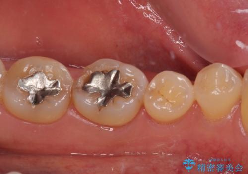銀歯の周りがむし歯に ゴールドインレーによるむし歯治療の治療前