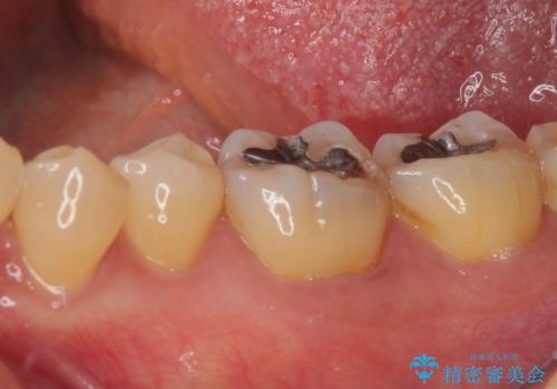 銀歯の周りがむし歯に ゴールドインレーによるむし歯治療の治療前