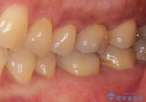 銀歯の周りがむし歯に ゴールドインレーによるむし歯治療の治療前
