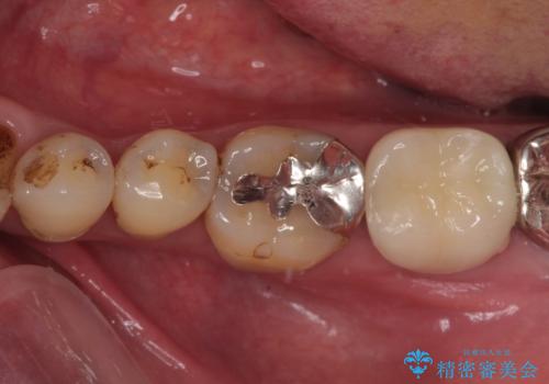 痛すぎて食事がとれない　奥歯の根管治療の症例 治療後