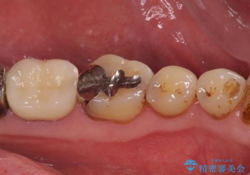 痛すぎて食事がとれない 奥歯の根管治療の治療後