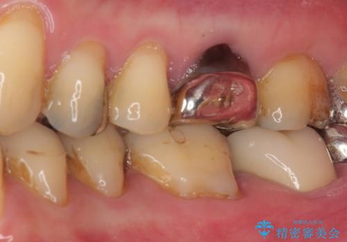 痛すぎて食事がとれない 奥歯の根管治療の治療後
