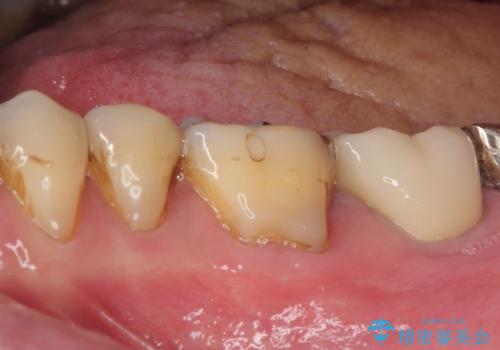 痛すぎて食事がとれない 奥歯の根管治療の治療後