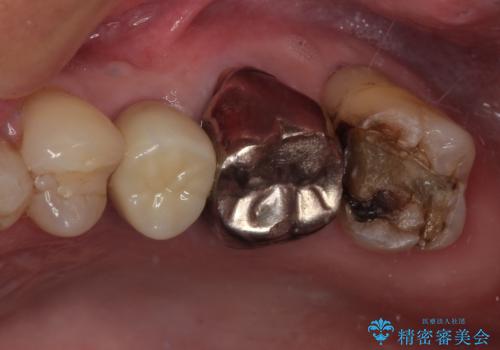 銀歯がとれたのでやり替えたい オールセラミッククラウンの症例 治療前