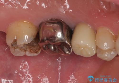 銀歯がとれたのでやり替えたい オールセラミッククラウンの治療前