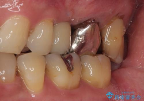 銀歯がとれたのでやり替えたい オールセラミッククラウンの治療前