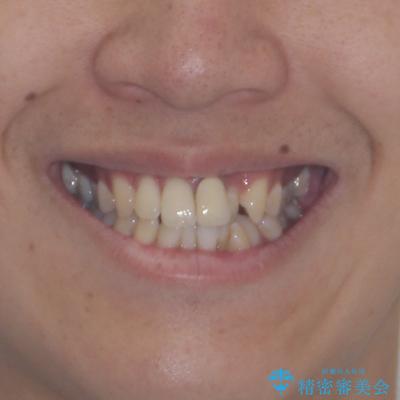 気になる前歯のデコボコと八重歯 ワイヤー矯正ですっきりとの治療前(顔貌)