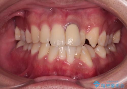 気になる前歯のデコボコと八重歯 ワイヤー矯正ですっきりとの治療前