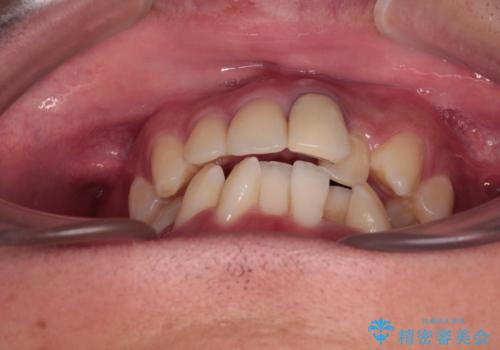 気になる前歯のデコボコと八重歯 ワイヤー矯正ですっきりとの治療前