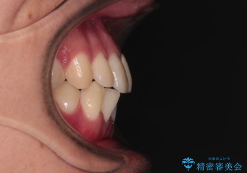 気になる前歯のデコボコと八重歯 ワイヤー矯正ですっきりとの治療前