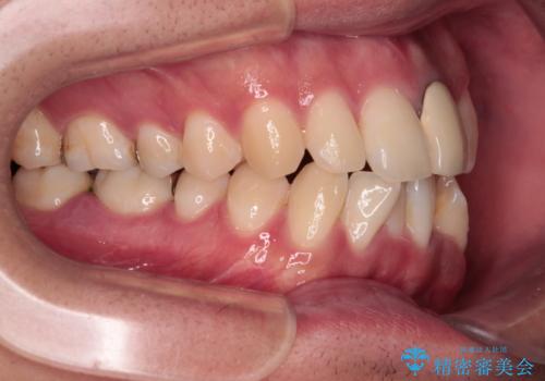 気になる前歯のデコボコと八重歯 ワイヤー矯正ですっきりとの治療前