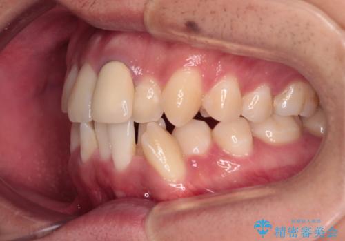 気になる前歯のデコボコと八重歯 ワイヤー矯正ですっきりとの治療前
