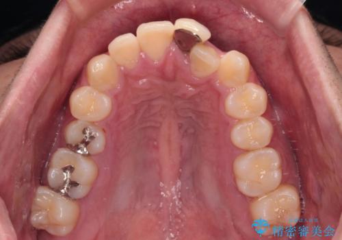 気になる前歯のデコボコと八重歯 ワイヤー矯正ですっきりとの治療前