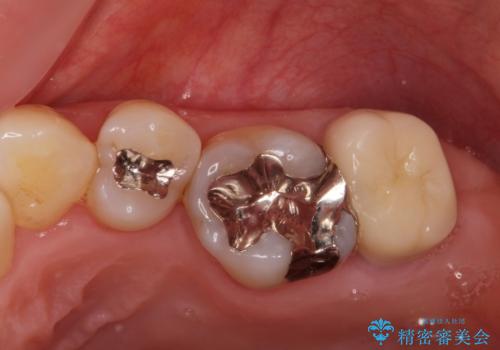 銀歯を白くしたいセラミック治療。の治療後