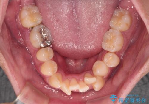 気になる前歯のデコボコと八重歯 ワイヤー矯正ですっきりとの治療前